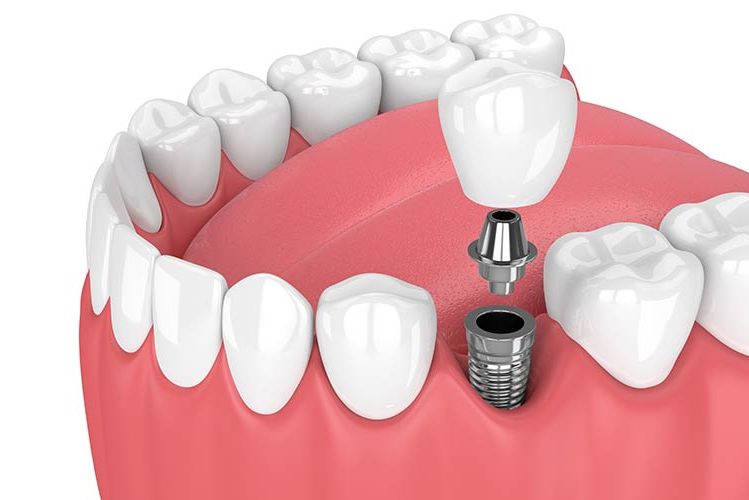 Brücken, Zahnkronen und Veneers