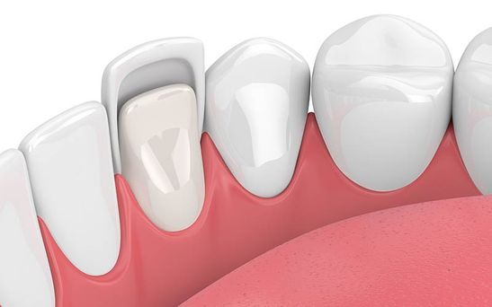  Veneers