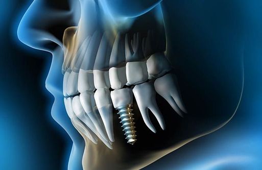 Implantat